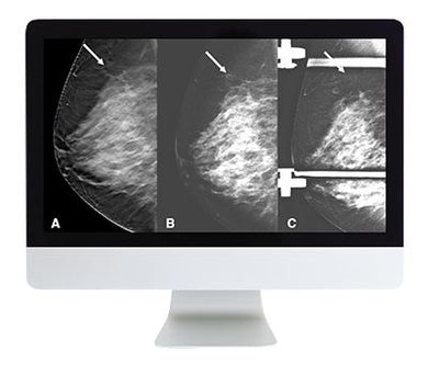 ARRS Breast Imaging: Screening and Diagnosis | Medical Video Courses.
