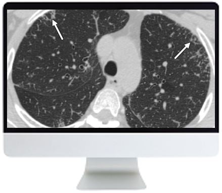ARRS Clinical Case-Based Review of Cardiopulmonary Imaging 2019 | Medical Video Courses.