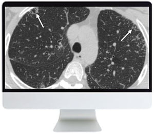 基于ARRS临床案例的心肺成像2019年回顾|眼科杂志医学视频课程。