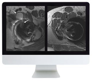 Tranh cãi ARRS trong chụp ảnh vùng hông và xương chậu | Các khóa học video y tế.