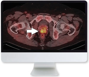 Hình ảnh phân tử ARRS và điều trị ung thư tuyến tiền liệt 2020 | Các khóa học video y tế.