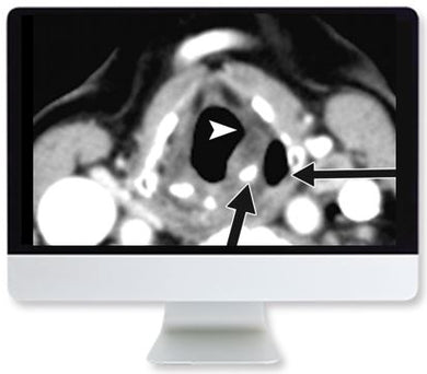 ARRS Thyroid Cancer Therapy: Go High, Go Low, or Go Home 2020 | Medical Video Courses.