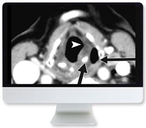 Terapia contra o cancro de tiroide ARRS: subir, baixar ou ir a casa 2020 | Cursos de vídeo médico.