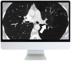 ARRS Basic Chest Imaging 2019 | Medical Video Courses.