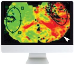 ARRS Code Stroke: What the Radiologist Needs to Know in the Changing Landscape of Acute Ischemic Stroke 2019 | Medical Video Courses.