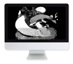 ARRS Highlights in Thoracic and Cardiovascular Imaging 2019 | Medical Video Courses.