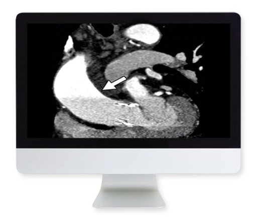 ARRS Highlights in Thoracic and Cardiovascular Imaging 2019 | Medical Video Courses.