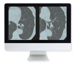 ARRS Lung Cancer Screening A Comprehensive Guide Online Course 2015 | Medical Video Courses.