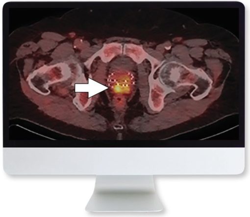 ARRS Molecular Imaging and Therapy of Prostate Cancer 2020 | Medical Video Courses.