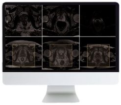 ARRS Pearls and Pitfalls in Prostate and Pelvic Imaging 2021