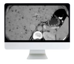 ARRS State of the Art Imaging for Chronic Liver Disease 2021