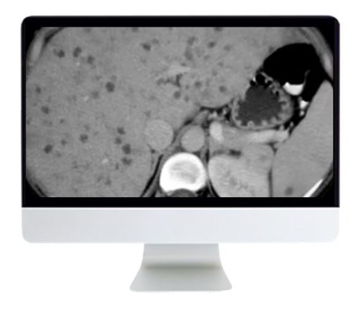 ARRS State of the Art Imaging for Chronic Liver Disease 2021