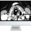 ARRS Thyroid Cancer Therapy: Go High