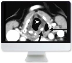 ARRS Thyroid Cancer Therapy: Go High