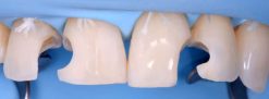 Gidedental Direct and Indirect Adhesive Restorations – Minimal Invasive Treatment of the Anterior and Posterior Damaged Dentition using Direct Bonded Restorations 2020