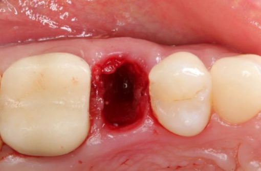 Gidedental Extraction Socket – Preservation/Grafting; Immediate vs Delayed Implants; Pontic Site Development 2020