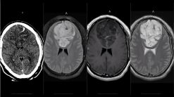 MRIOnline Imaging Mastery Series: Adult Glioma Imaging 2021