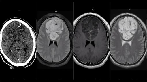 MRIOnline Imaging Mastery Series: Adult Glioma Imaging 2021