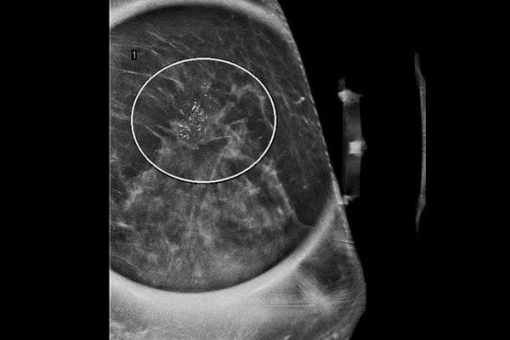 MRIOnline Imaging Mastery Series: High Risk Screening Breast MRI 2021