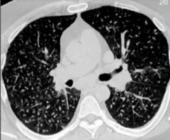 MRIOnline Imaging Mastery Series: Micronodules 2021