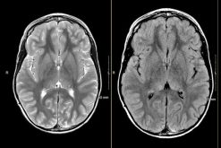 MRIOnline Imaging Mastery Series: Neurocutaneous Syndromes 2021