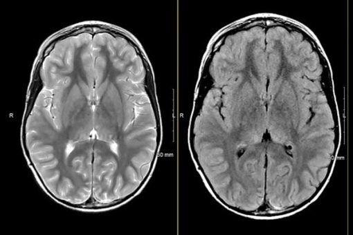 MRIOnline Imaging Mastery Series: Neurocutaneous Syndromes 2021