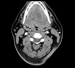 MRIOnline Imaging Mastery Series: Pathology of the Oral Cavity and Oropharynx 2020