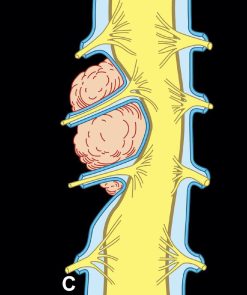 MRIOnline MRI Mastery Series: Extradural Lesions 2020