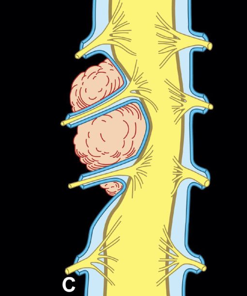 MRIOnline MRI Mastery Series: Extradural Lesions 2020