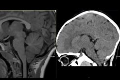 MRIOnline MRI Mastery Series: Infratentorial/Posterior Fossa Defects 2021