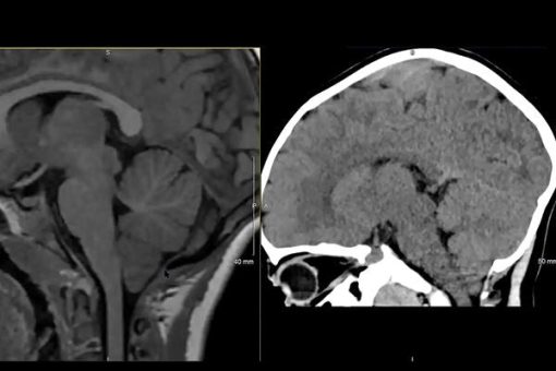 MRIOnline MRI Mastery Series: Infratentorial/Posterior Fossa Defects 2021