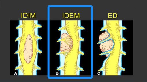 MRIOnline MRI Mastery Series: Intradural Extramedullary Lesions (IDEM) 2020