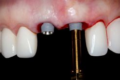 Online Residency Program: A-Z in Implant Dentistry 2021
