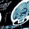 Stroke and Other Common Neurological Conditions | Medical Video Courses.