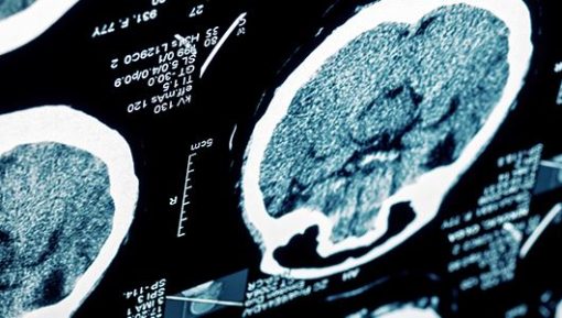 Stroke and Other Common Neurological Conditions | Medical Video Courses.